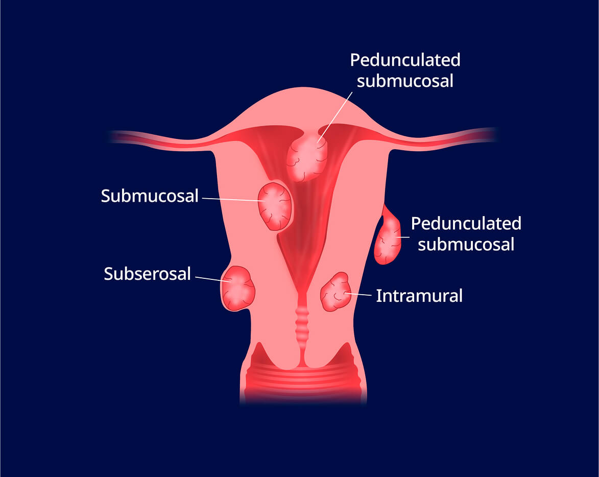 An illustration of uterine fibroids in a uterus, including the types of fibroids